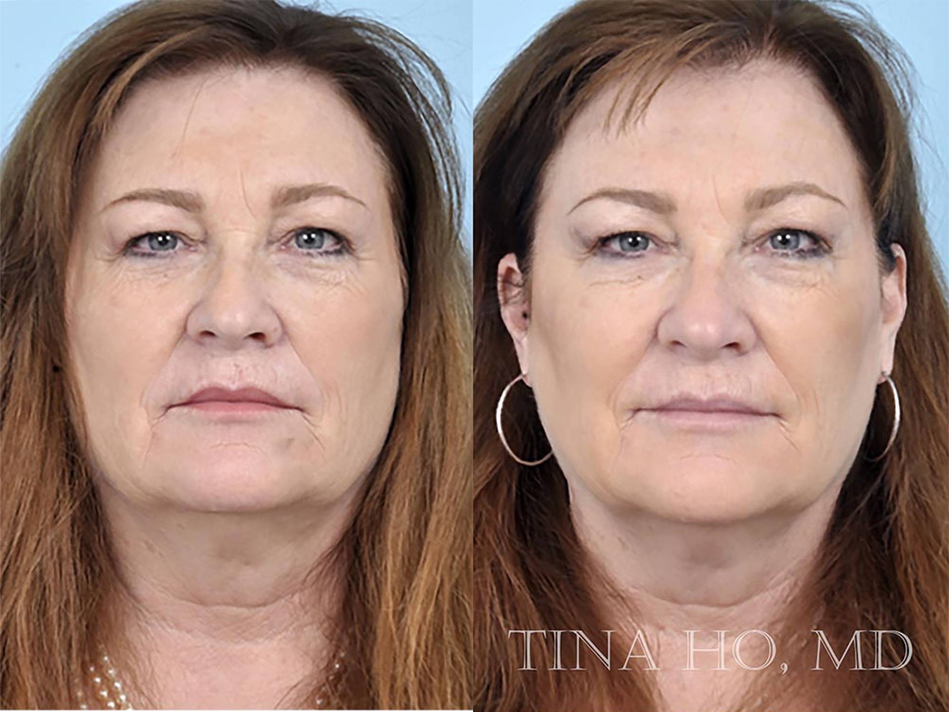 liquid face lift before and after 