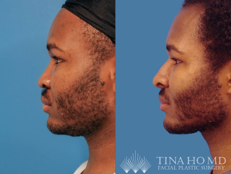ethnic rhinoplasty - left lateral view