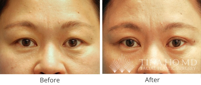 Asian Double Eyelid Surgery