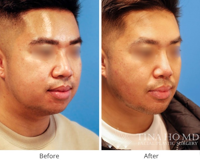 ethnic rhinoplasty - left lateral view
