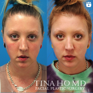 Injectables facial contouring