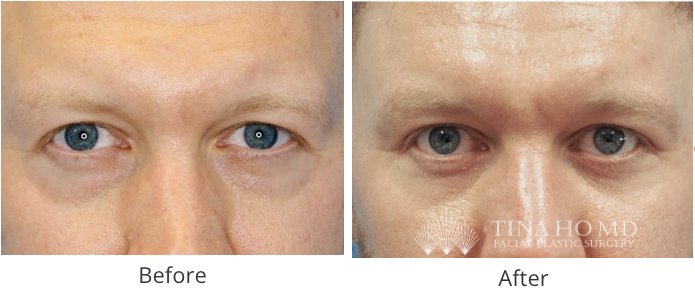 lower eyelid surgery before and after 