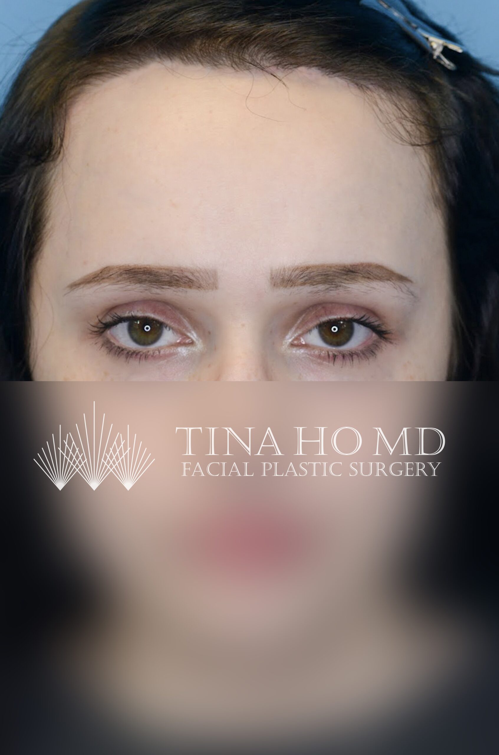 forehead reduction patient in Philadelphia after photo 