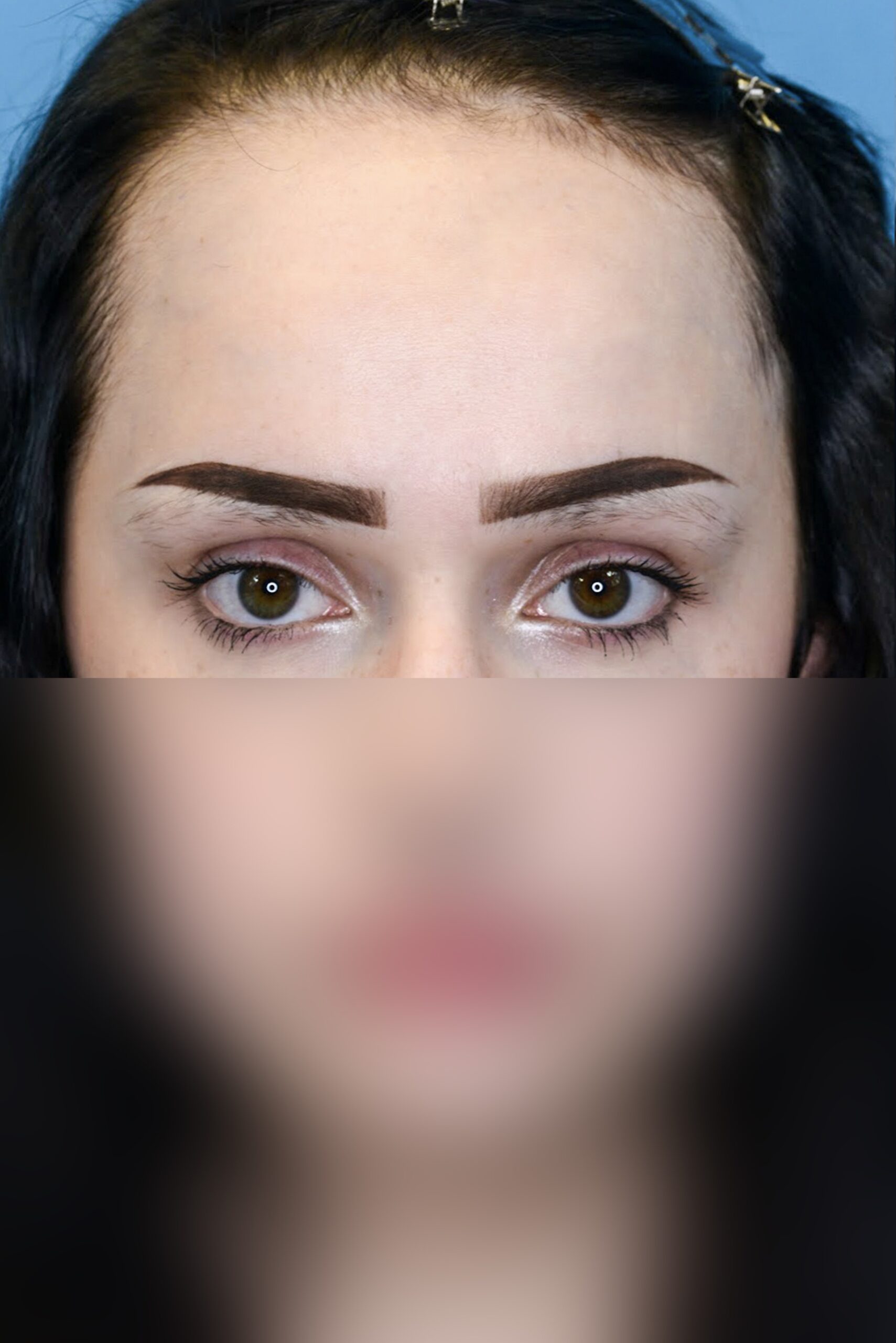 forehead reduction patient in Philadelphia before photo 