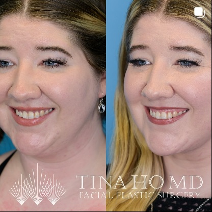 Deep Neck Lift Before and After