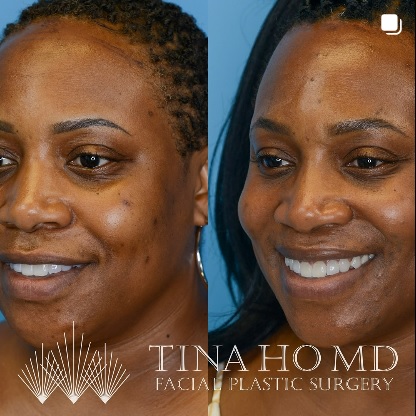 Forehead Reduction Patient 2 Before and After