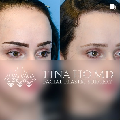 Forehead Reduction Patient Before and After