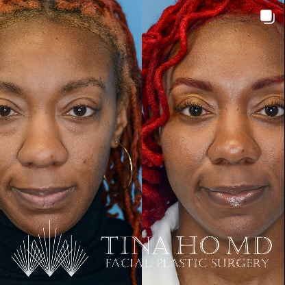 Lower Eyelid Surgery Patient Before and After