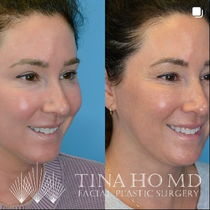 Neck Lift and Eyelid Surgery Before and After