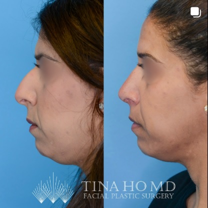 Rhinoplasty Patient Before and After