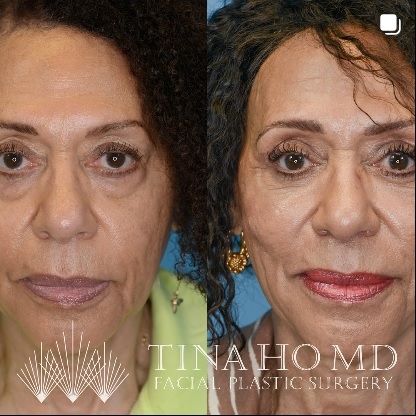 Upper and Lower Eyelid Surgery Before and After