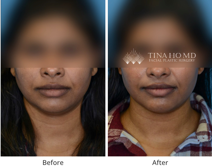 Mini Neck Lift Before & After Philadelphia, Wayne, & Main Line.